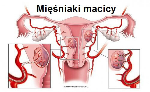 miesniaki-macicy Mięśniaki macicy