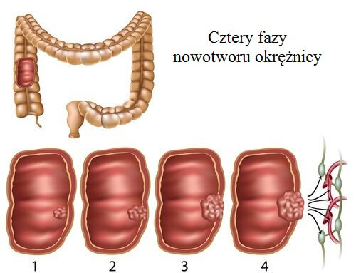 Rak okrężnicy: etapy