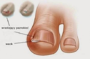 Wrastające paznokcie - 6 starych sposobów