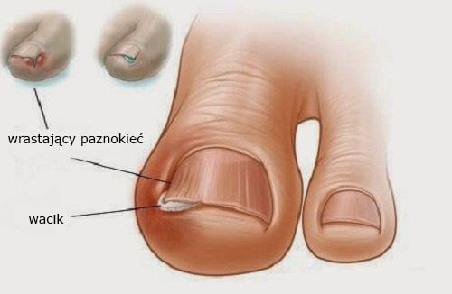 Wrastający paznokieć problemy z paznokciami