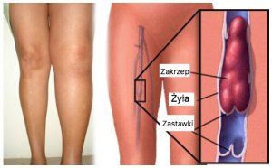 Zakrzepica żył - jak jej uniknąć?