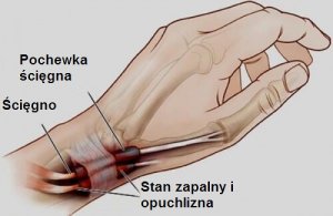 Zapalenie ścięgna - stopy i nadgarstki