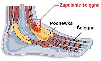 Zapalenie ścięgna w stopie