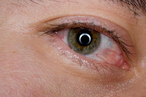 Jak ukoić zmęczone oczy? Oto 6 domowych sposobów