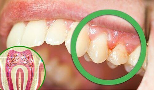 Ząb boli? Oto 6 możliwych przyczyn