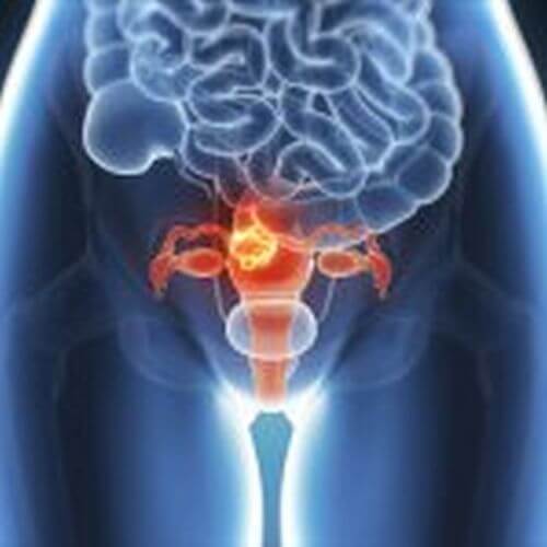 Endometrioza – zagrożenia i objawy ukrytej choroby