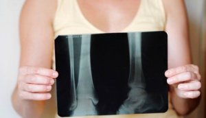 Menopauza - Jak zadbać o kości?