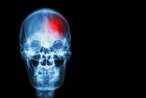Udar mózgu – objawy, które powinieneś znać