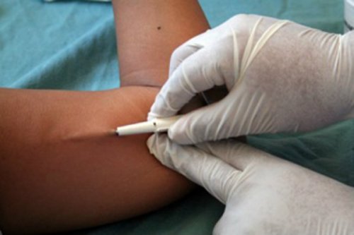implant podskórny antykoncepcja