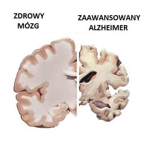 mozg-choroba-alzheimera