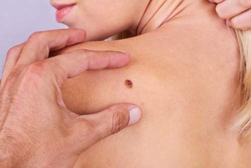 Rak skóry – 7 rzeczy, jakie należy o nim wiedzieć
