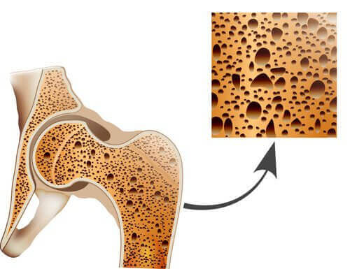 Osteoporoza - walcz z nią naturalnymi metodami