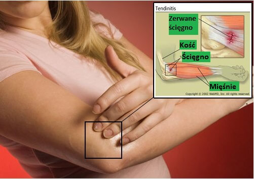 Zapalenie ścięgna