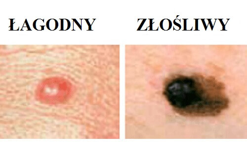 Pieprzyki – Wszystko co powinniście o nich wiedzieć