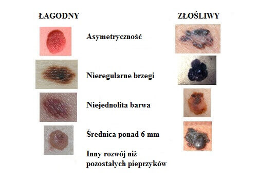 Rak skóry - pieprzyki