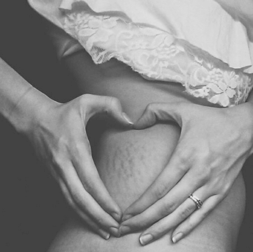 Rozstępy na biodrach