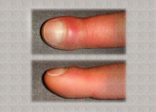 Obrzęk palców - co go powoduje? Poznaj przyczyny