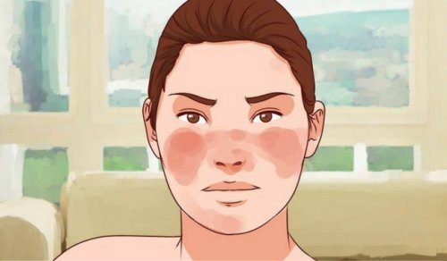 toczeń jest chorobą immunologiczną