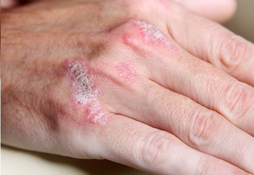 Choroby autoimmunologiczne – 5 rzeczy, które należy wiedzieć