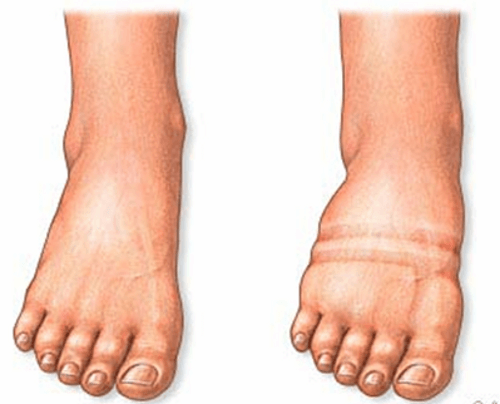 nadmiar wody w tkankach stopy