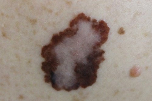 rak skóry w formie nieregularnego pieprzyka