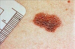 Rak skóry - objawy, których nie powinieneś ignorować