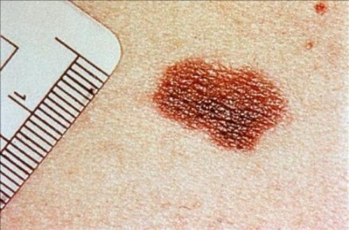 Rak skóry – objawy, których nie powinieneś ignorować
