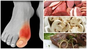 Dna moczanowa? Unikaj tych 7 produktów spożywczych!