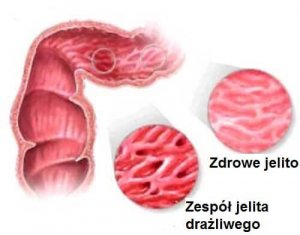 Zespół jelita drażliwego - 4 porady, by złagodzić objawy