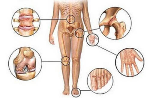 Ból stawów - 5 naturalnych zabiegów przeciwzapalnych
