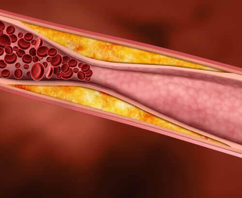 cholesterol w żyle