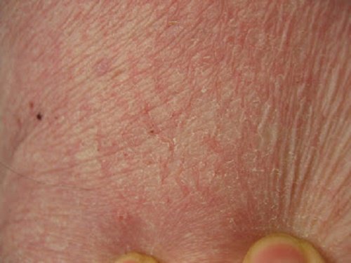 Sucha skóra i jej pielęgnacja w różnych częściach ciała