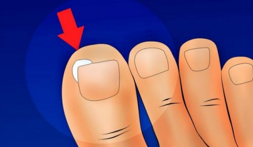 Wrastające paznokcie - w jaki sposób tego unikać