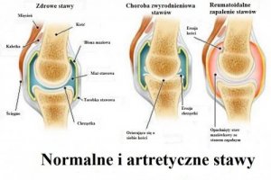 Zapalenie stawów, zwyrodnienia i osteoporoza – różnice