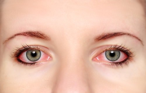 Zapalenie spojówek wywołane przez suchość oczu