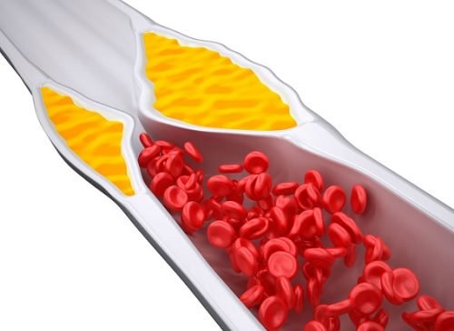 zły-cholesterol Zły cholesterol
