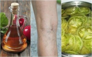 Żylaki nóg – jak je skutecznie zwalczyć?