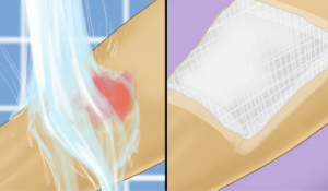 Pierwsza pomoc przy oparzeniach wodą