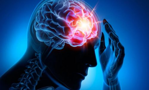 Choroby naczyń mózgowych – cztery najczęstsze