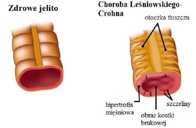Choroba Leśniowskiego-Crohna
