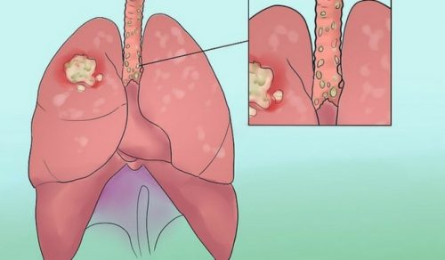 Objawy raka płuc – nie lekceważ ich!