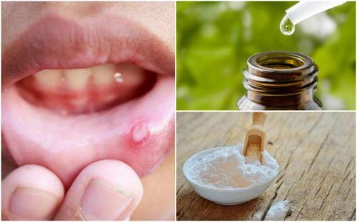 Owrzodzenie jamy ustnej – 6 naturalnych leków