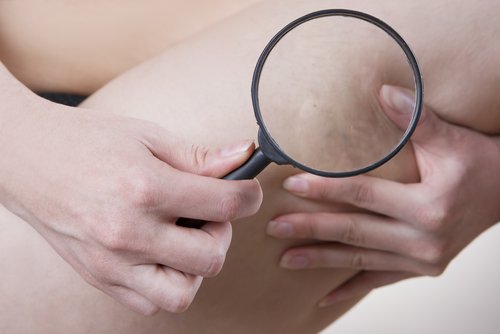 Siniak, cellulit a obcisłe ubrania