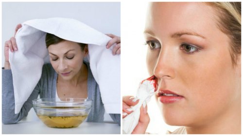 Krwawienie z nosa – 7 domowych sposobów