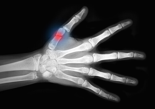 Złamanie palca osteoporoza