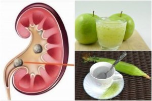 Kamienie nerkowe – Jak rozpuścić je naturalnie?