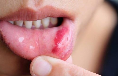 Rak jamy ustnej – objawy, leczenie i zapobieganie
