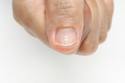 Bruzdy na paznokciach - przyczyny i leczenie