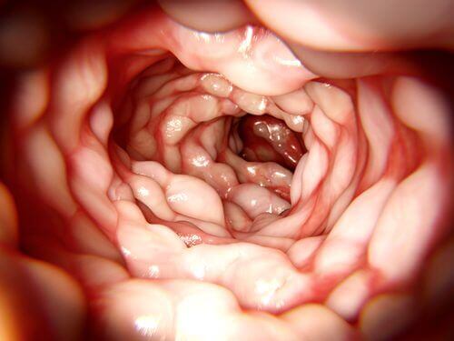 Choroba Crohna - Zakażenie żołądka i jelit