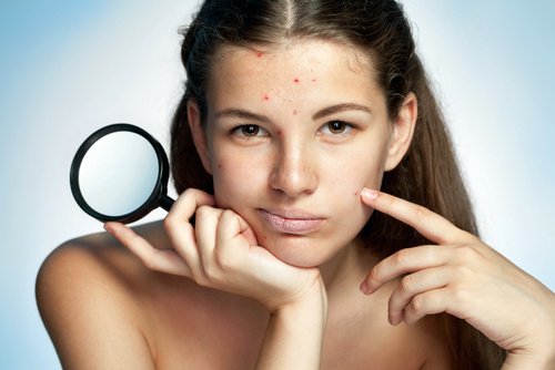 dziewczyna z trądzikiem na czole i lusterkiem - zaburzenia hormonalne